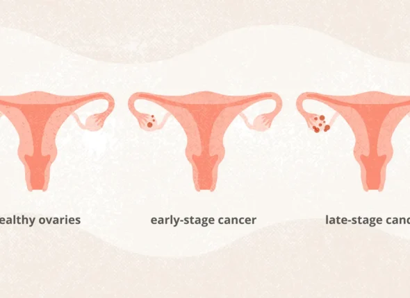 the-stages-of-ovarian-cancer-and-what-they-mean-1440x810