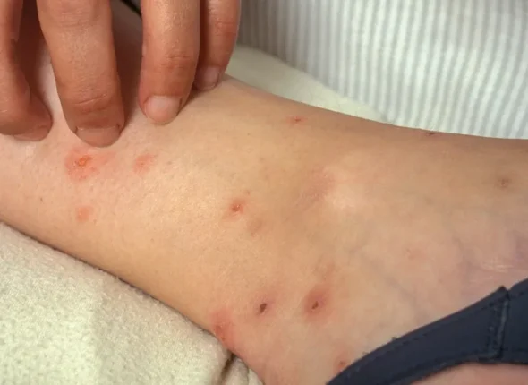 Flea-bites-of-the-lower-leg-body9
